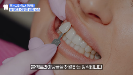 Black Triangle: 4 Ways to Fix the Gap Between Teeth <Revealed> image 19