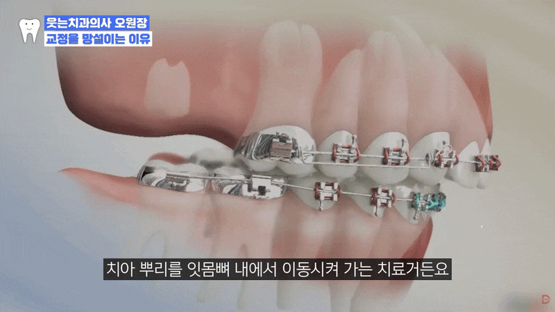 강남 치과 성인 덧니, 교정으로 해결하는 게 좋을까요? 관련 이미지 6