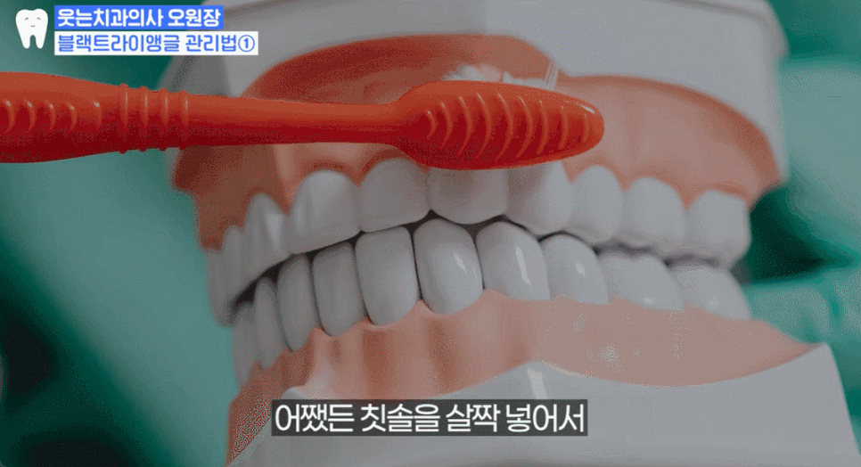 Black Triangle: 4 Ways to Fix the Gap Between Teeth <Revealed> image 16