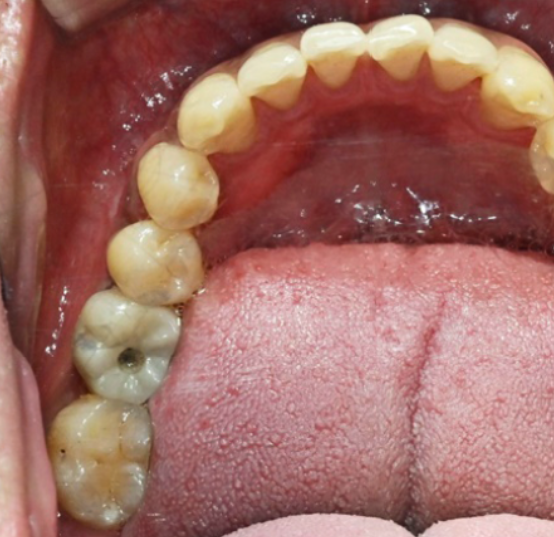 Implant Costs and Health Insurance Implant Coverage Criteria - If You Really Want to Save on Costs image 5