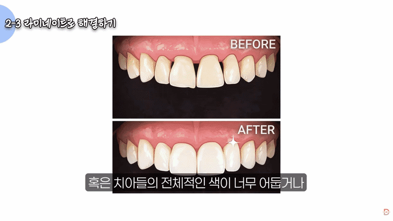 논현역 치과 라미네이트, 레진 치료만으로 충분할지 고민된다면 관련 이미지 12