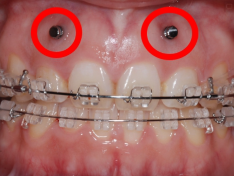 Why Are Invisalign Screws Placed, and How Much Do They Hurt? image 5