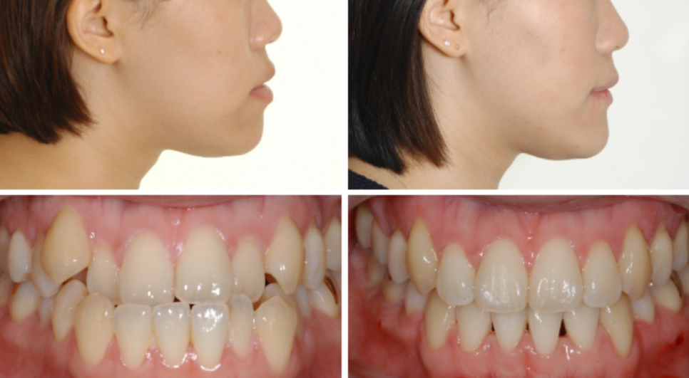 Can Non-Surgical Underbite Correction Really Be Done Without Surgery? Orthodontic Clinic Recommendation image 2