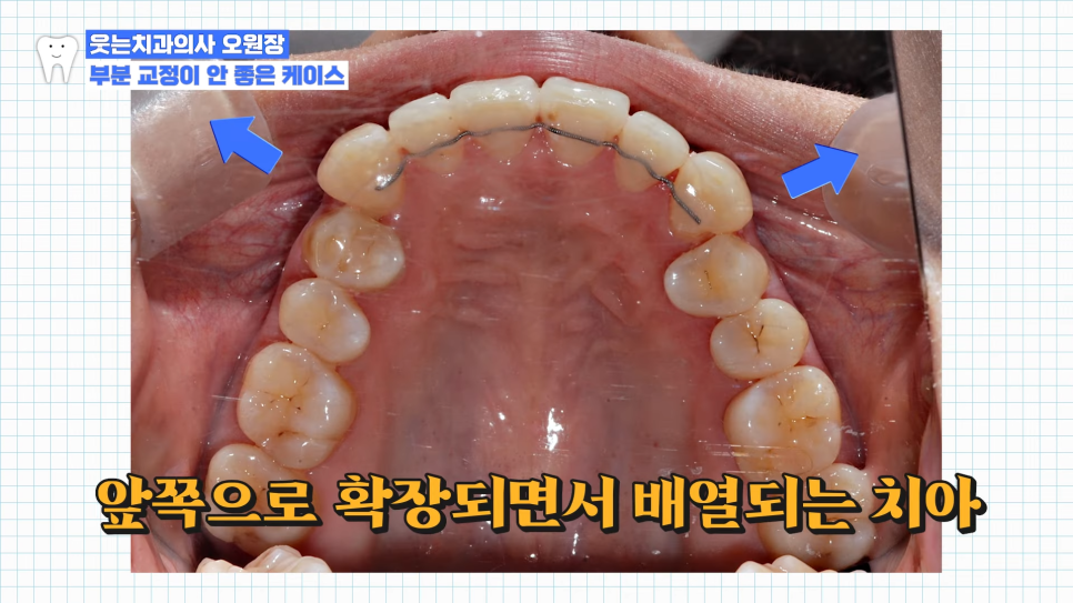부분교정하고 이렇게 변했습니다 교정 전후 비교 관련 이미지 14
