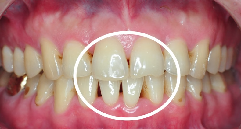 Black Triangle: 4 Ways to Fix the Gap Between Teeth <Revealed> image 11