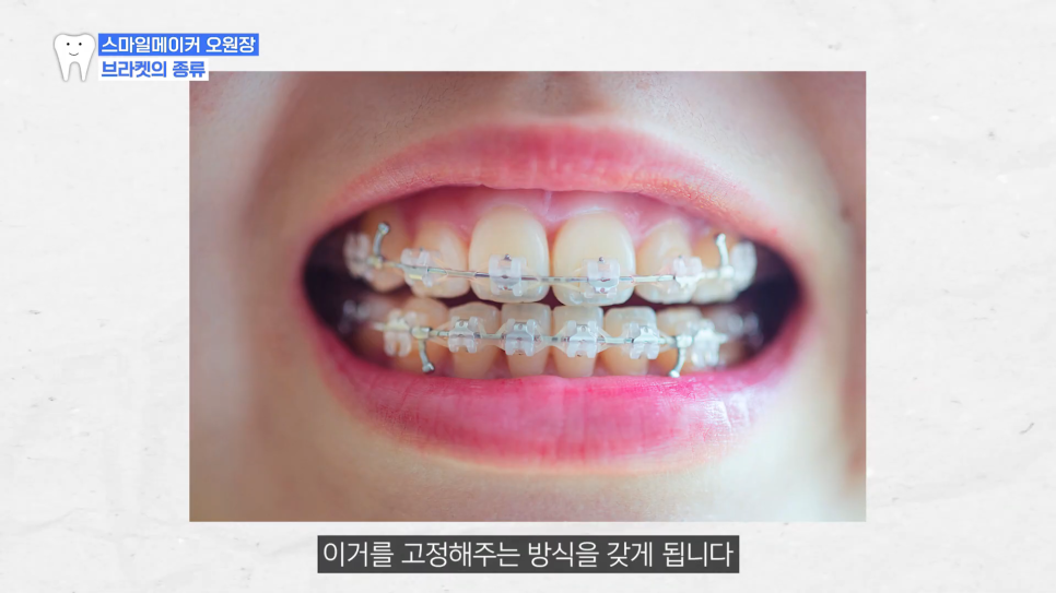 인비절라인 퍼스트로 철사 찔림없이 덜 아프게? 엄마표 교정 선택법 관련 이미지 6