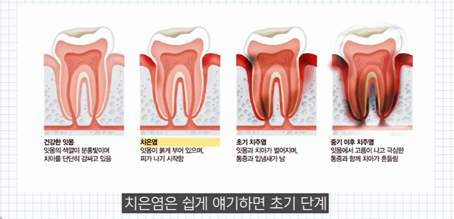 잇몸 염증 원인과 치료법 (치은염, 치주염 전격 분석) 관련 이미지 3