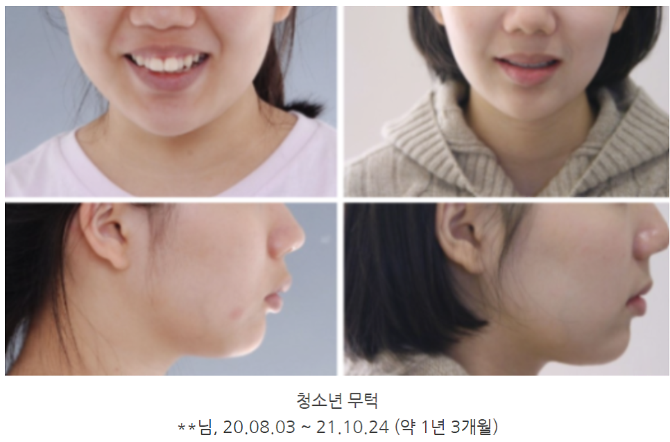 무턱교정전후, 얼굴 라인 어떻게 달라지는지 <공개> 관련 이미지 7