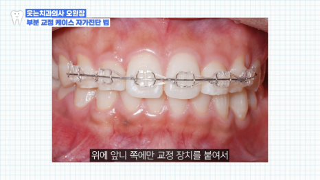 치아교정 앞니부분교정 가능할까? <전문의 답변> 관련 이미지 4