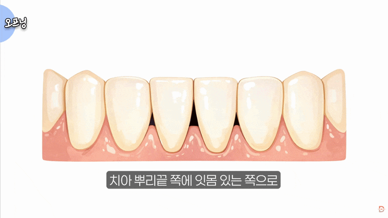 블랙트라이앵글 치료, 강남치과는 어떻게 해결할까? 관련 이미지 3