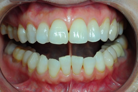 Laminates Review? Teeth Whitening? This Is for People Worried About Yellow Teeth image 2