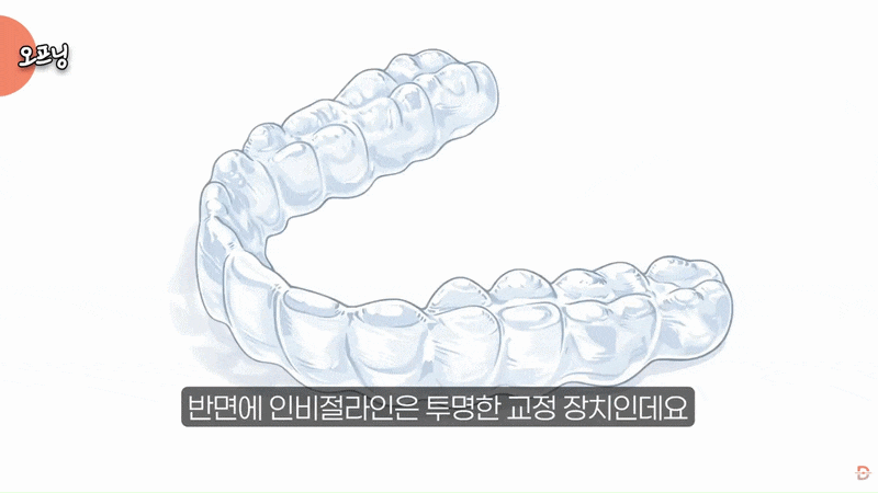 설측교정? 인비절라인? 티 안 나는 교정으로 뭐가 좋을까? 관련 이미지 3