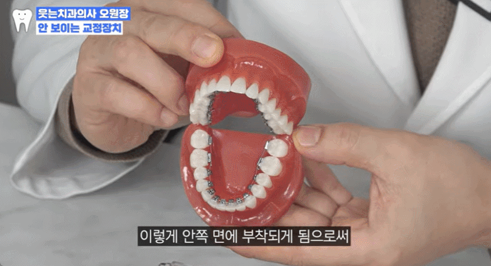 Before and After Protruding Mouth Correction: Principles, Advantages, and Disadvantages of Clear Aligners and Lingual Orthodontics for Protruding Mouth image 3