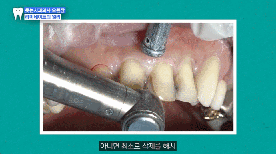 Laminates Review? Teeth Whitening? This Is for People Worried About Yellow Teeth image 6