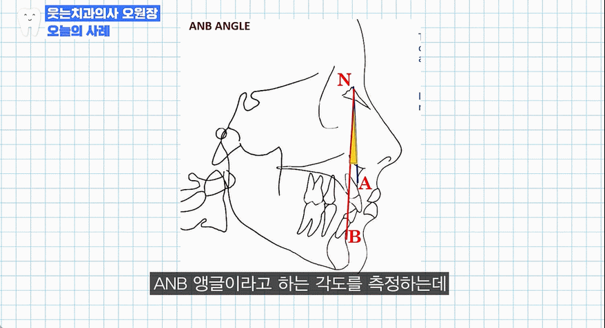 주걱턱 교정 VS 양악수술? 교정과 전문의가 답변드립니다 관련 이미지 11