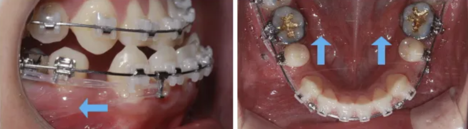 Protruding Mouth Correction and Underbite Correction: A Case Improved Without Surgery image 10