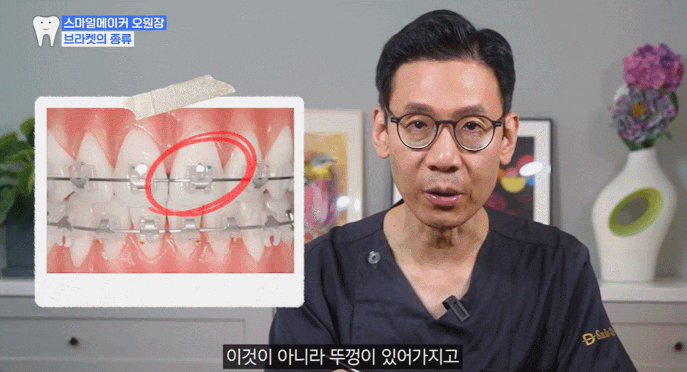 Apgujeong Dental Clinic: Types of Orthodontic Treatment and Selection Criteria <1-Minute Key Summary> image 5