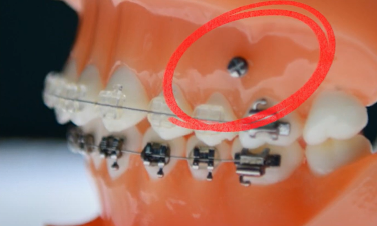 Why Are Invisalign Screws Placed, and How Much Do They Hurt? image 1