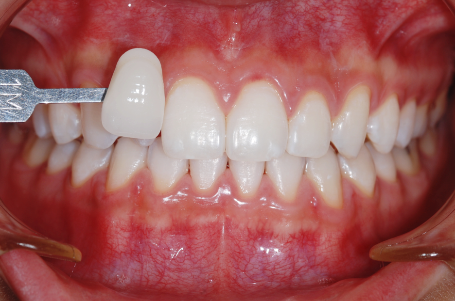 Laminates Cost, How to Restore Discolored Dental Resin to White image 4