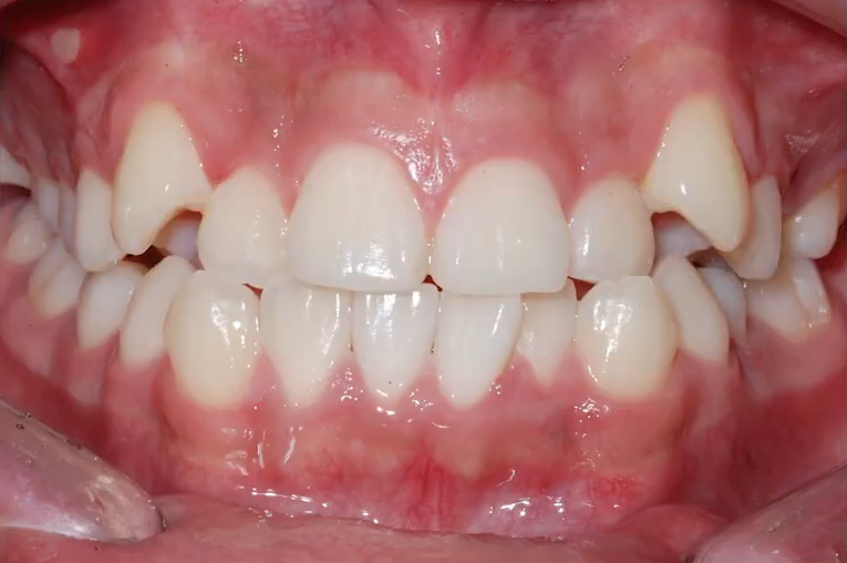 악궁확장 장치로 발치 피한 교정 사례, 나도 가능할까? 관련 이미지 5