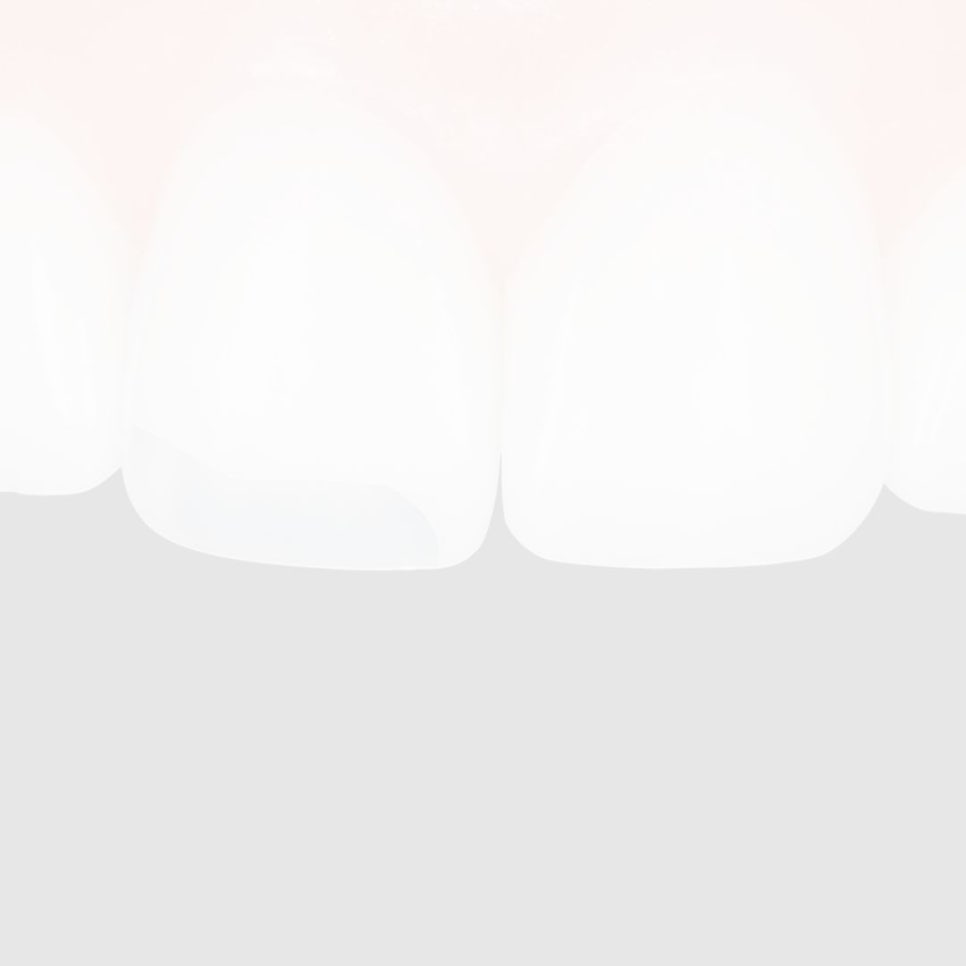 어린이 부정교합, 무턱 교정은 &lsquo;성장기 타이밍&rsquo;이 중요해요 관련 이미지 37