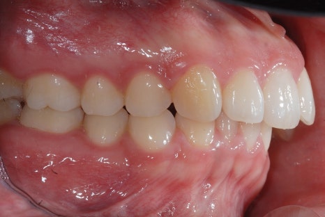 교정했는데 "합죽이입매" 됐다면? 옥니교정 골든타임, 더 늦기 전에 관련 이미지 5