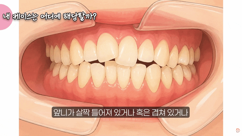 압구정교정치과, 앞니만 가지런하면 끝이라고 생각하셨나요? 관련 이미지 1