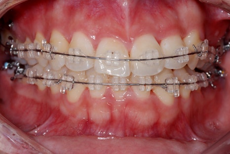 덧니 라미네이트와 덧니 교정, 뭐가 더 나을까요? < 18년차 전문의 답변> 관련 이미지 8