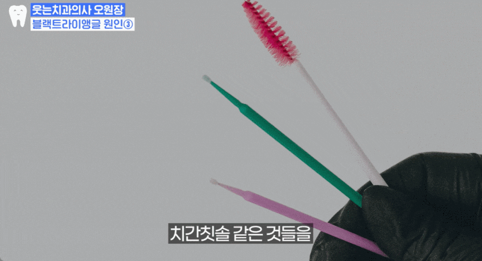 Black Triangle: 4 Ways to Fix the Gap Between Teeth <Revealed> image 13