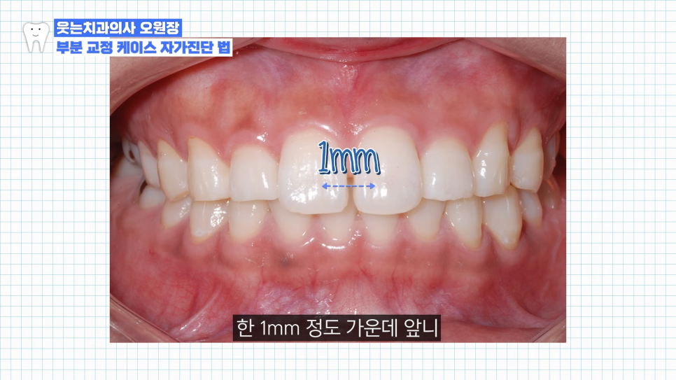 부분교정하고 이렇게 변했습니다 교정 전후 비교 관련 이미지 9