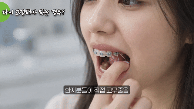 치아교정 고무줄, 하루 몇 시간 착용해야 할까요? 관련 이미지 12