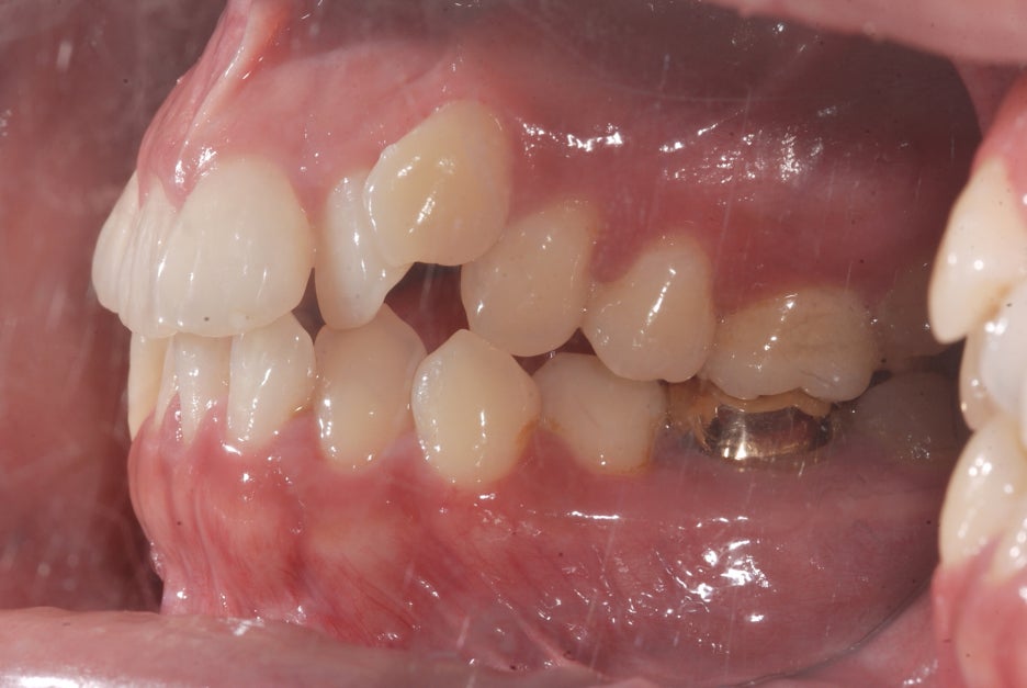 Gap Between the Front Teeth? Don’t Judge It by Front Teeth Partial Orthodontic Reviews Alone image 3