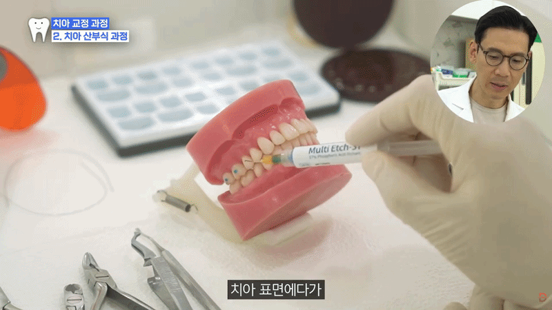 The Orthodontic Process: Do Teeth Start Moving Immediately After Brackets Are Attached? image 2