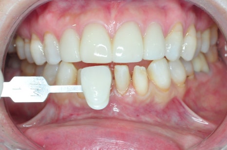 For Those Who Want an Attractive Smile with Cosmetic Prosthetics.. Tip from a Dentist at Sinsa Station Dental Clinic image 12