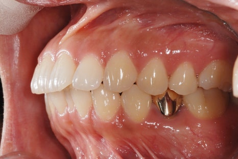 Key Points You Need to Know About Orthodontic Treatment Costs and Non-Extraction Orthodontics image 11