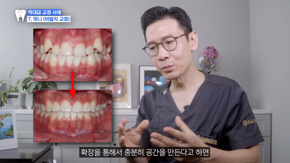 악궁확장 장치로 발치 피한 교정 사례, 나도 가능할까? 관련 이미지 1