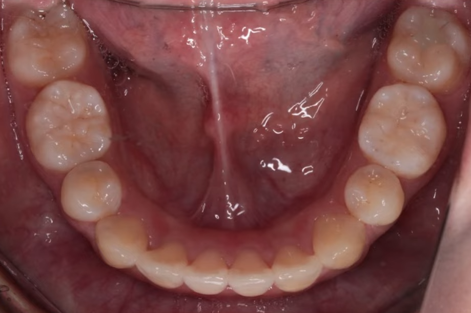 돌출입수술 대신, 인비절라인 돌출입 개선 사례 관련 이미지 14