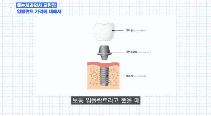 20대임플란트, "제가 벌써요?" 고민만 하다간 돈&middot;시간 두 배로 나갑니다. 관련 이미지 4