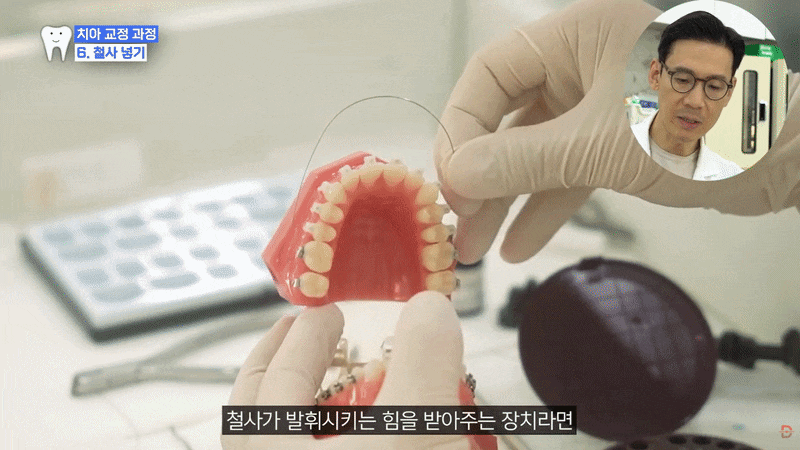 The Orthodontic Process: Do Teeth Start Moving Immediately After Brackets Are Attached? image 11