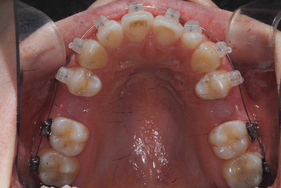 What Is the Key to Correcting Deep Bite and Inward-Tipped Teeth? Must Read to Avoid Retreatment image 11