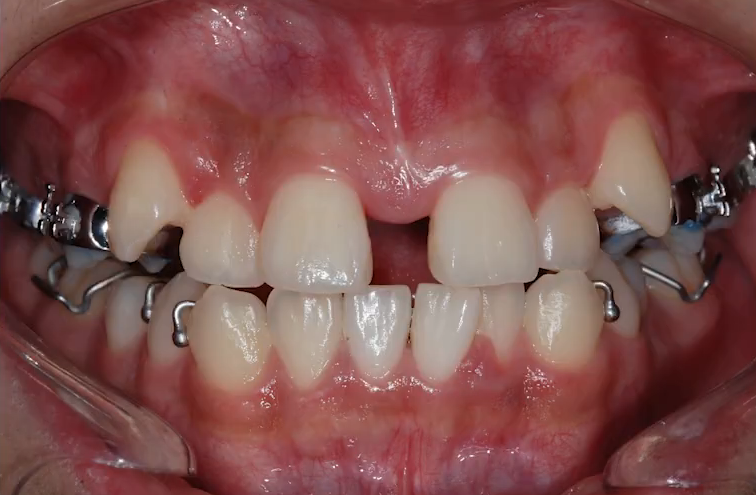 악궁확장 장치로 발치 피한 교정 사례, 나도 가능할까? 관련 이미지 11