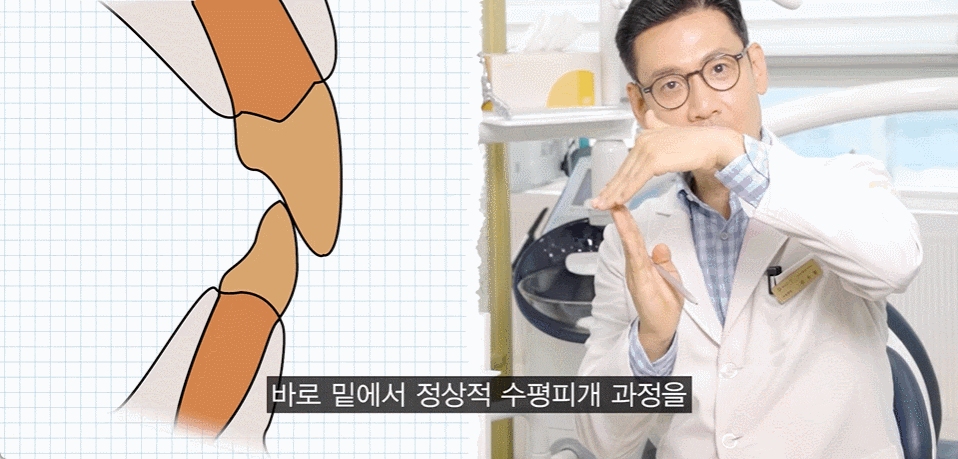 Underbite Tooth Correction? How to Improve a Receded Chin Without Double-Jaw Surgery or Chin Surgery image 9