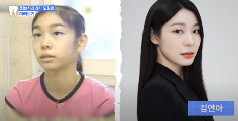 Protruding Mouth Correction Period? Can It Turn Out Like a Celebrity Before-and-After? image 1