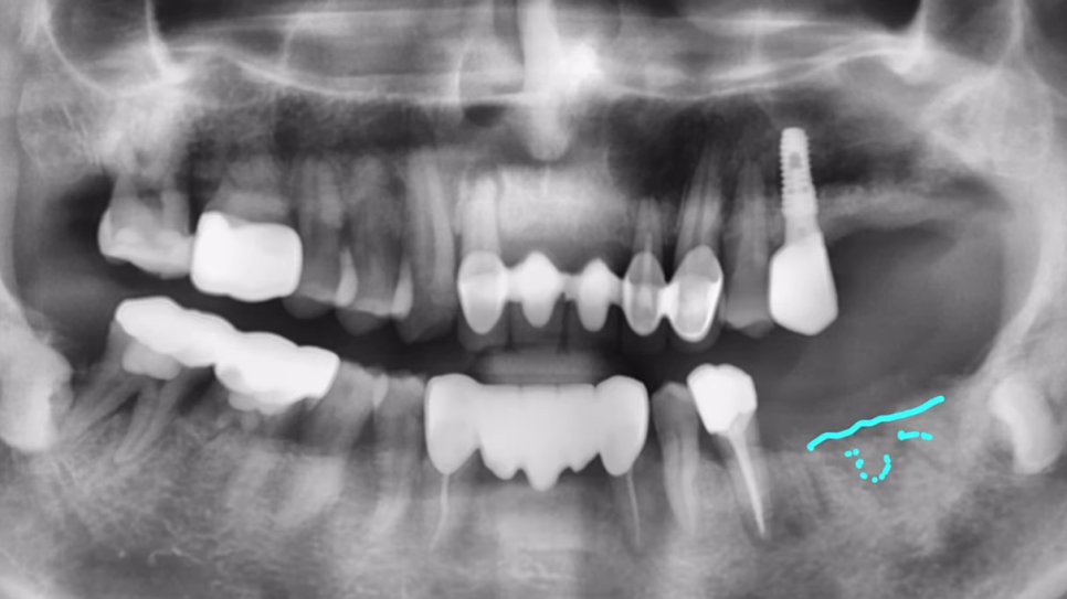 임플란트수술, 당일임플란트로 빠르게 끝내고 싶으신가요? 관련 이미지 10