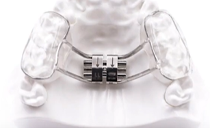 덧니교정 비발치로도 가능할까? 관련 이미지 5