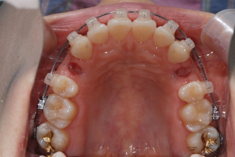 Key Points You Need to Know About Orthodontic Treatment Costs and Non-Extraction Orthodontics image 12