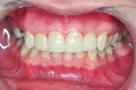 무삭제 라미네이트 부작용 없으려면? 이 한 가지는 꼭 확인하세요 관련 이미지 4