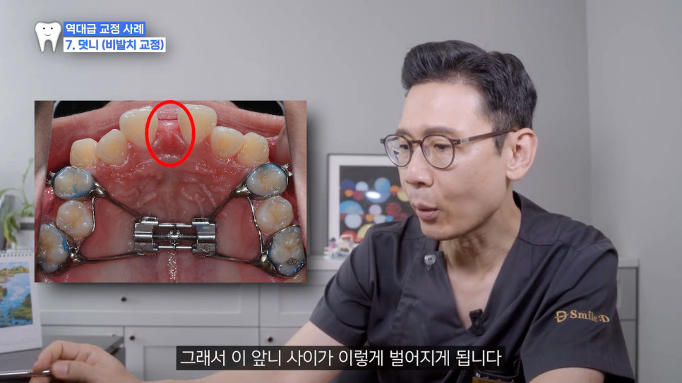 악궁확장 장치로 발치 피한 교정 사례, 나도 가능할까? 관련 이미지 10