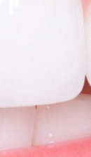 What to Check Before Choosing a Gangnam Laminate Dental Clinic image 33