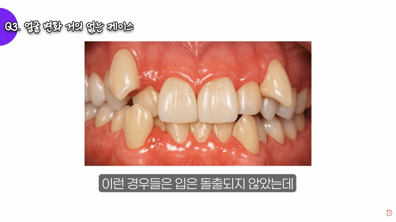 Apgujeong Orthodontic Clinic: Can Orthodontic Treatment Change the Shape of Your Face? image 8